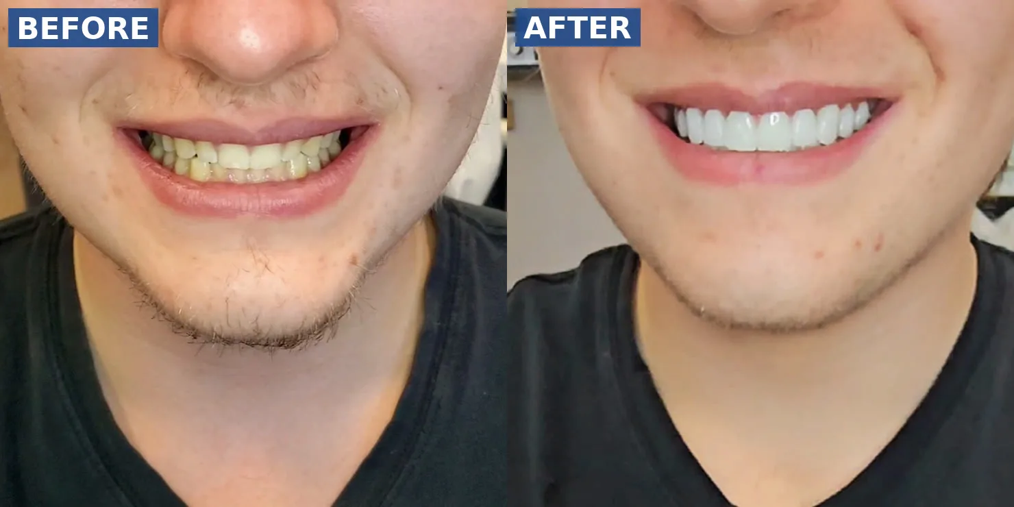 Before and after porcelain veneers on a real Premier Smiles patient in North Dallas — yellow, uneven teeth replaced with a bright, even smile